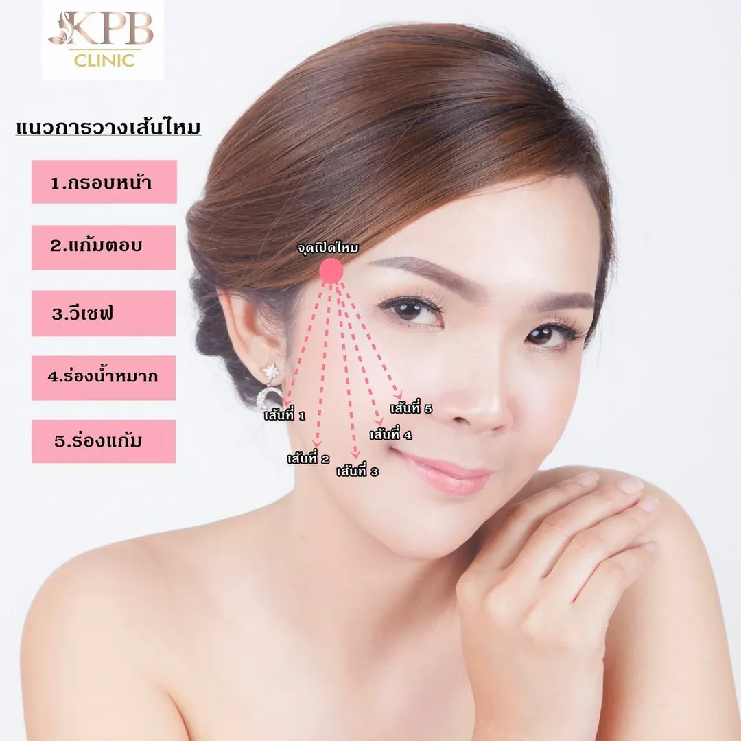 ตัวอย่างแนวการวางเส้นไหมบนใบหน้า KPB Clinic