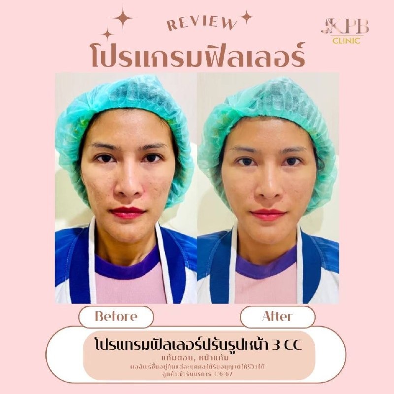 รีวิวโปรแกรมฟิลเลอร์ปรับรูปหน้า KPB Clinic