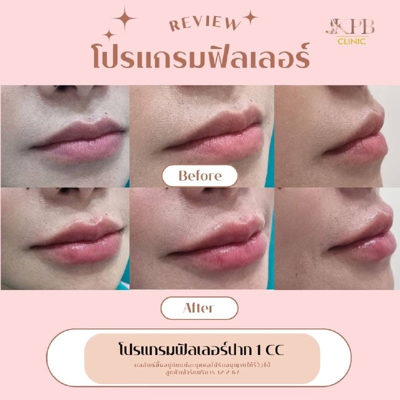 รีวิวโปรแกรมฟิลเลอร์ปาก KPB Clinic