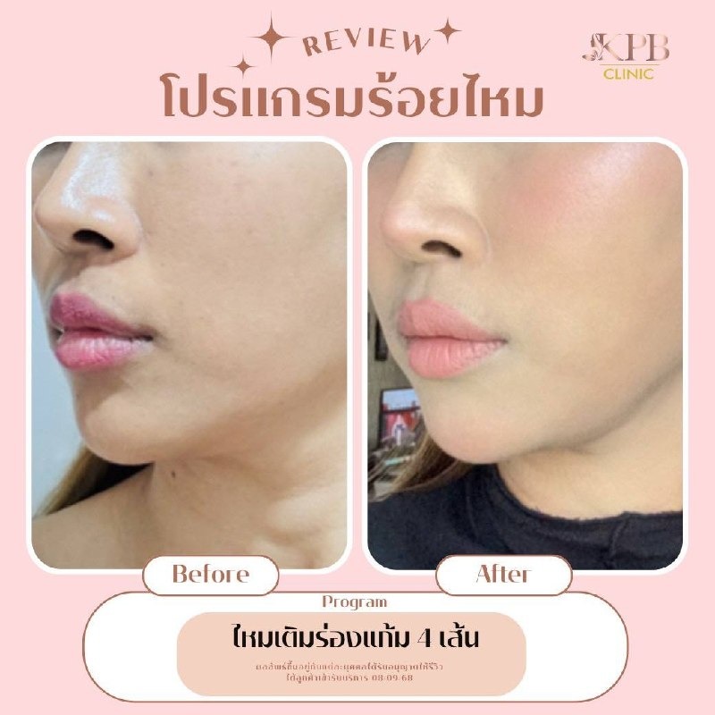 รีวิวโปรแกรมร้อยไหมเติมร่องแก้ม KPB Clinic