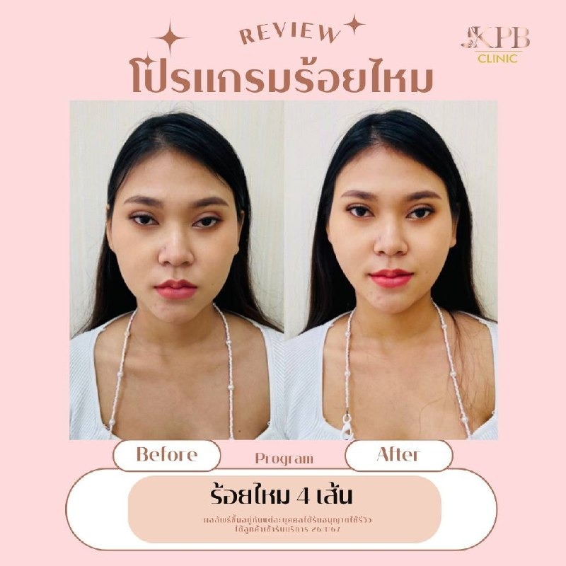 รีวิวโปรแกรมร้อยไหม KPB Clinic ลำดับที่ 1