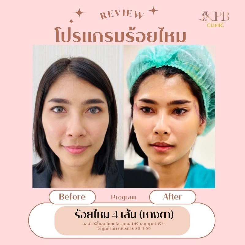 รีวิวโปรแกรมร้อยไหม KPB Clinic ลำดับที่ 6