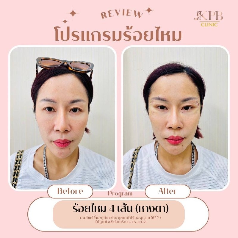 รีวิวโปรแกรมร้อยไหม KPB Clinic ลำดับที่ 7